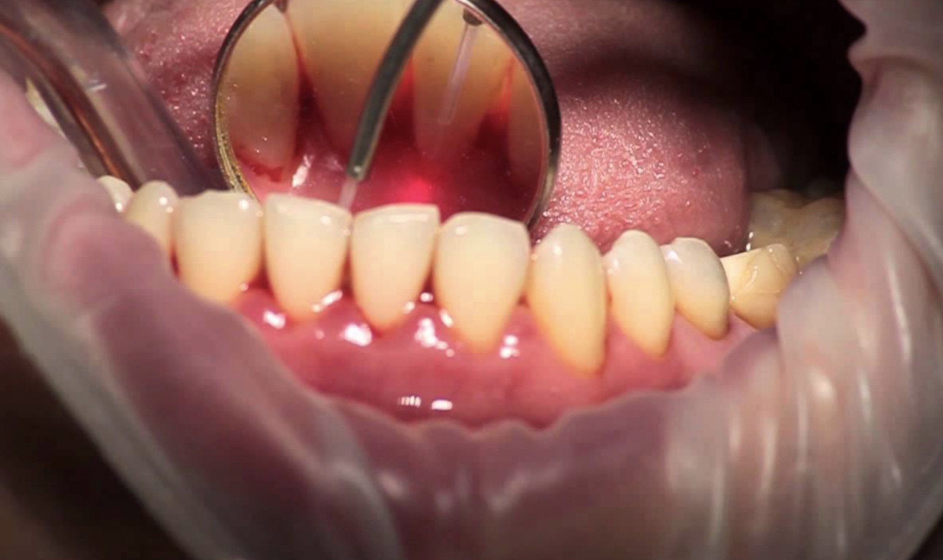 Лазерное лечение зубов