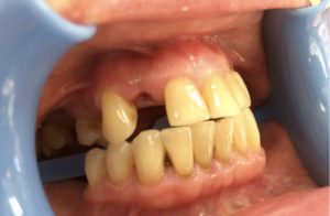 Отсутствует зуб: почему мы теряем зубы и чем их заменить?