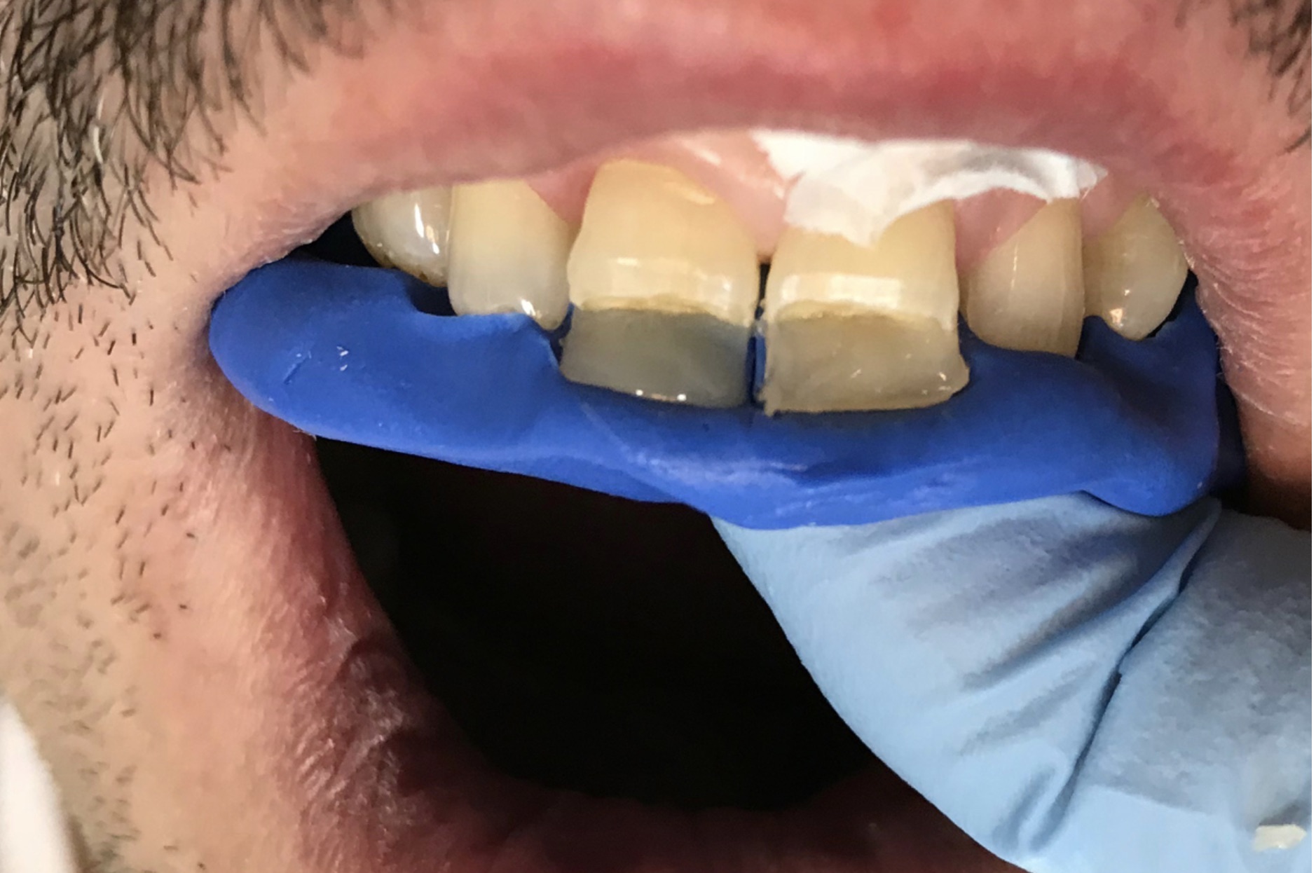 Реконструкция зуба